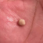 tonsil stones