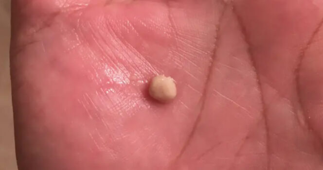 tonsil stones