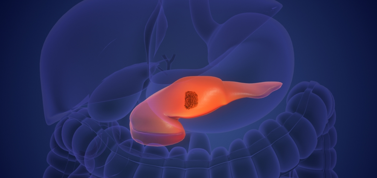 How a Spanish lab made pancreatic tumors disappear in mice without triggering resistance