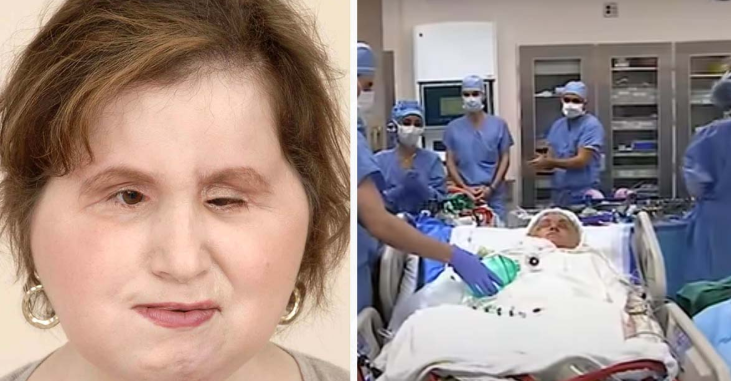 The incredible story of Katie Stubblefield: she became the youngest person ever to receive a face transplant