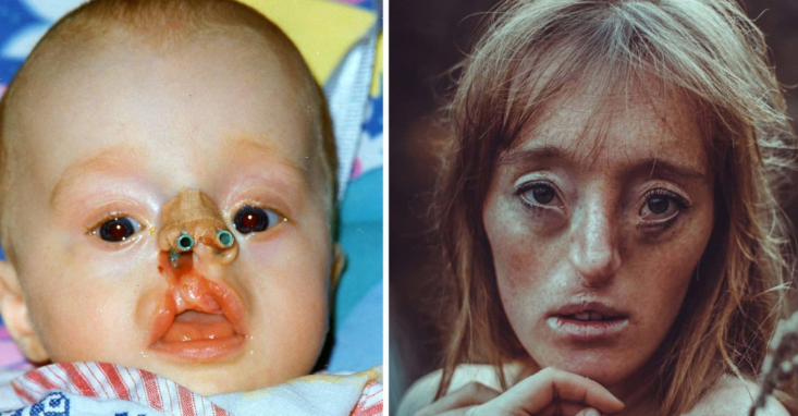 Ilka Brühl was born with a rare facial defect — now she’s breaking beauty standards with her modeling career