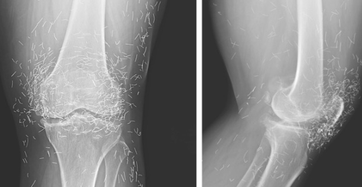 Doctors discover a “gold mine” inside a woman’s knees