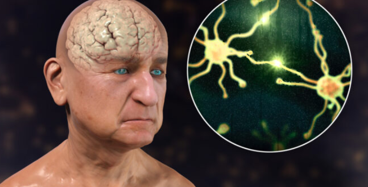 dementia