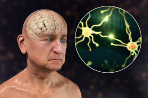dementia