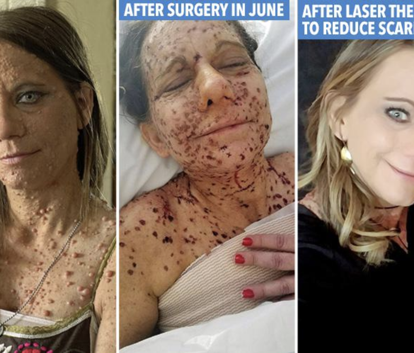 Mum cruelly branded a ‘toad’ due to thousands of tumors covering her body reveals dramatic transformation after undergoing surgery
