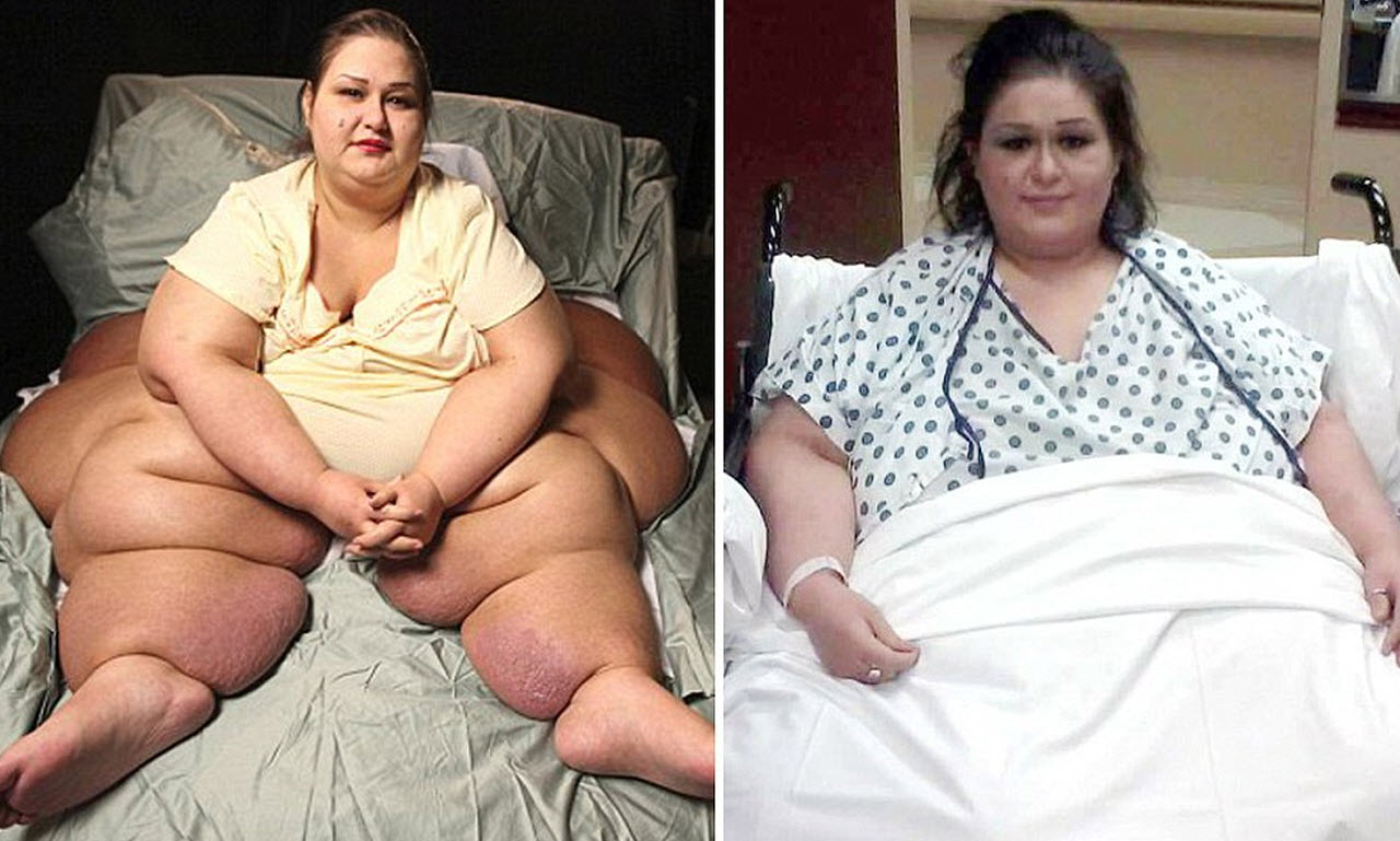 The World’s Most Obese Woman Goes Through An Amazing Transformation