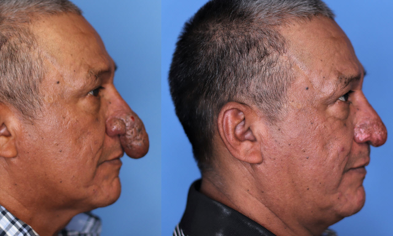 Conrado’s Nose Was Transformed Until We Couldn’t Recognize Him