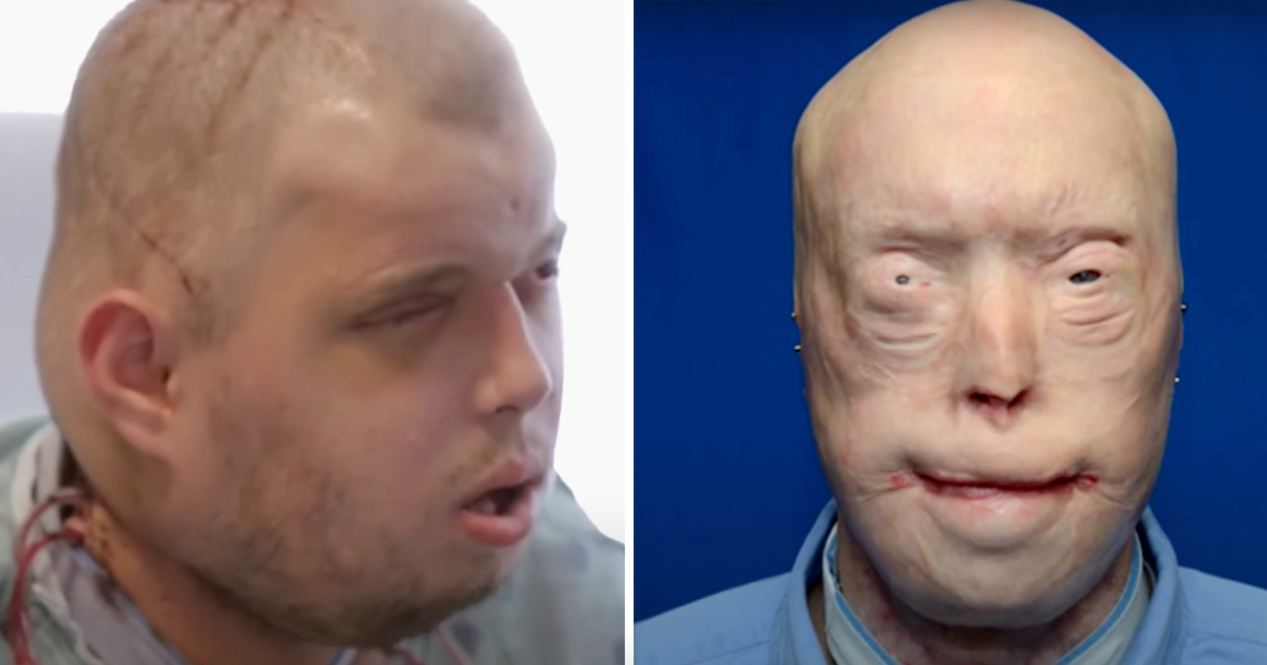 Patrick Hardison Face Transplant How a Firefighter Got a New Life