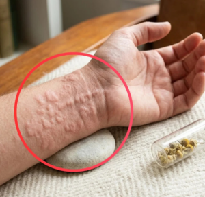 Chronic Hives